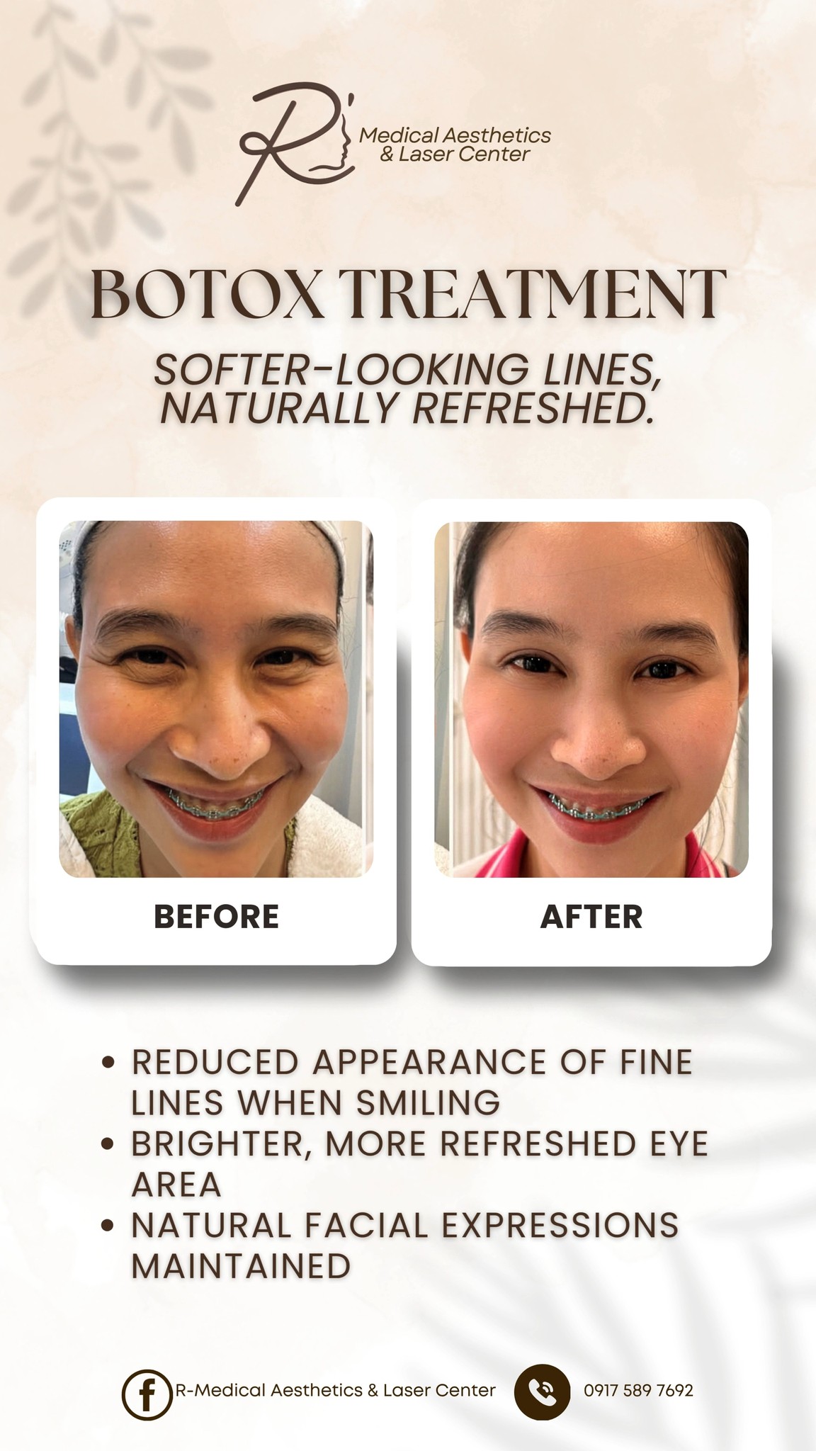 glutathione injection in tuguegarao ✨ 𝑺𝒐𝒎𝒆𝒕𝒊𝒎𝒆𝒔, 𝒕𝒉𝒆 𝒔𝒎𝒂𝒍𝒍𝒆𝒔𝒕 𝒄𝒉𝒂𝒏𝒈𝒆𝒔 𝒄𝒓𝒆𝒂𝒕𝒆 𝒕𝒉𝒆 𝒃𝒊𝒈𝒈𝒆𝒔𝒕 𝒅𝒊𝒇𝒇𝒆𝒓𝒆𝒏𝒄𝒆., 👀 𝐄𝐯𝐞𝐫 𝐰𝐨𝐧𝐝𝐞𝐫𝐞𝐝 𝐰𝐡𝐲 𝐁𝐨𝐭𝐨𝐱 𝐢𝐬 𝐨𝐧𝐞 𝐨𝐟 𝐭𝐡𝐞 𝐦𝐨𝐬𝐭 𝐫𝐞𝐪𝐮𝐞𝐬𝐭𝐞𝐝 𝐚𝐞𝐬𝐭𝐡𝐞𝐭𝐢𝐜 𝐭𝐫𝐞𝐚𝐭𝐦𝐞𝐧𝐭𝐬?, This 𝐛𝐞𝐟𝐨𝐫𝐞-𝐚𝐧𝐝-𝐚𝐟𝐭𝐞𝐫 shows how Botox can help 𝐬𝐨𝐟𝐭𝐞𝐧 LENGTH:11 bpc 157 structure Predicted diy ingredient
