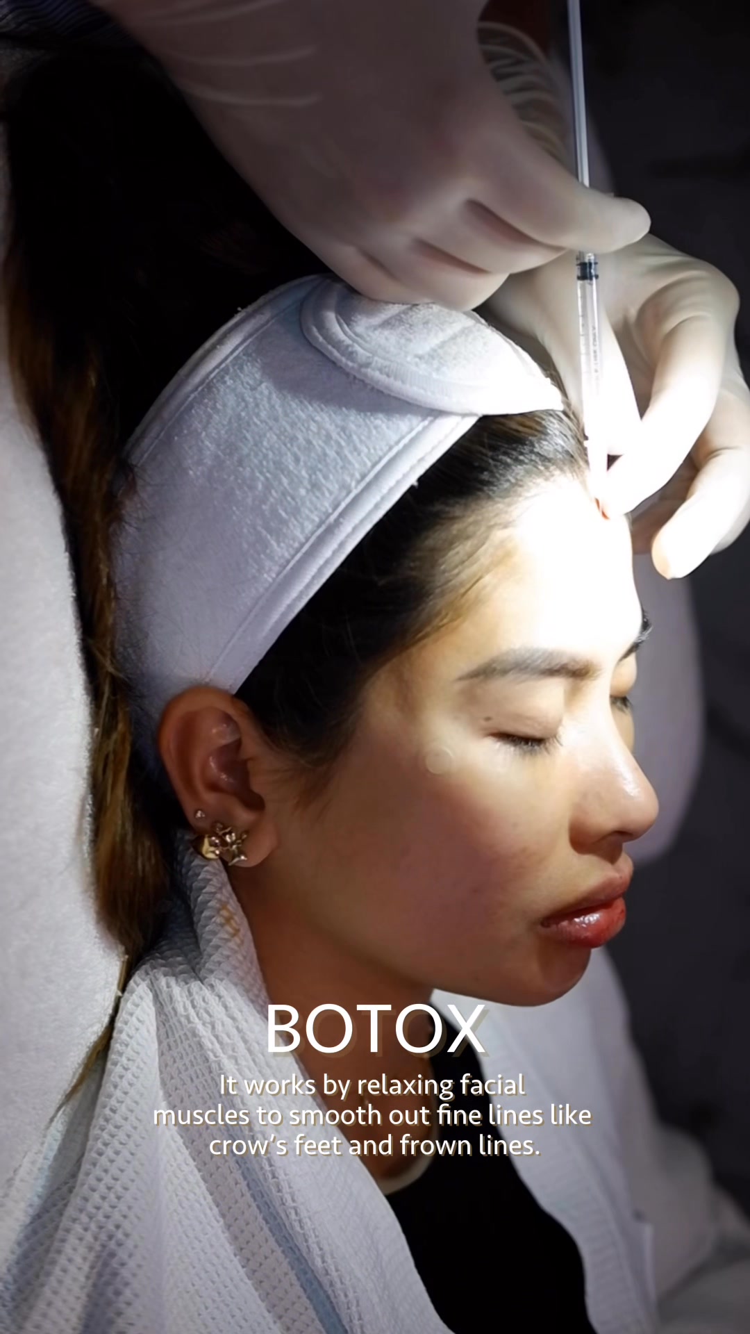 💉 What is Botox and how does it work? Botox is a purified protein that ...