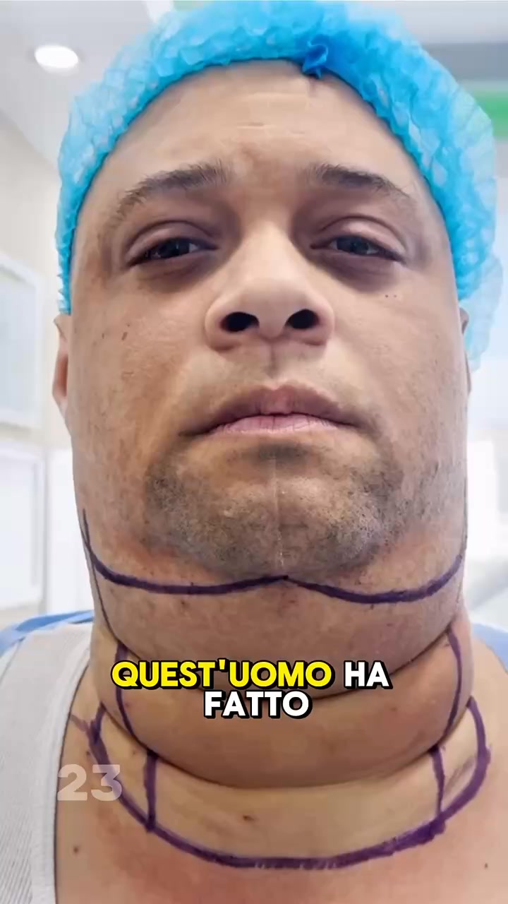 Ha fatto un intervento al mento e la trasformazione è davvero ...
