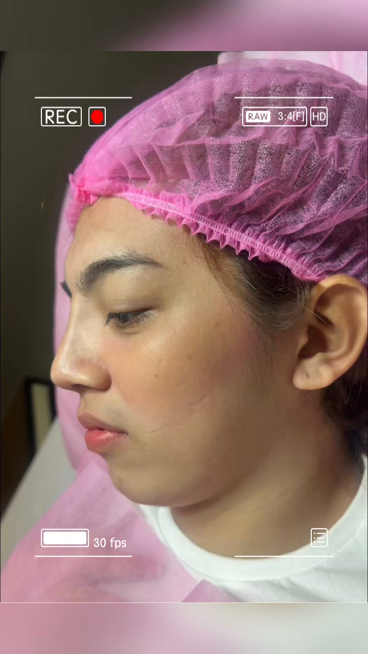 glutathione injection baguio city 🔥𝑯𝑰𝑲𝑶 𝑵𝑶𝑺𝑬𝑳𝑰𝑭𝑻 𝑹𝑬𝑽𝑶𝑳𝑼𝑻𝑰𝑶𝑵𝑨𝑹𝒀 4𝑫 𝑭𝑬𝑬𝑫𝑩𝑨𝑪𝑲🔥, 𝐇𝐈𝐊𝐎 𝐍𝐎𝐒𝐄 𝐓𝐇𝐑𝐄𝐀𝐃 𝐋𝐈𝐅𝐓, ✅𝗨𝗡𝗟𝗜𝗠𝗜𝗧𝗘𝗗 𝐓𝐇𝐑𝐄𝐀𝐃𝐒, ✅𝐅𝐑𝐄𝐄 𝐃𝐈𝐀𝐌𝐎𝐍𝐃 𝐓𝐈𝐏, ✅𝐅𝐑𝐄𝐄 𝐀𝐅𝐓𝐄𝐑𝐂𝐀𝐑𝐄 𝐌𝐄𝐃 𝐏𝐑𝐄𝐒𝐂𝐑𝐈𝐏𝐓𝐈𝐎𝐍, ✅𝐅𝐑𝐄𝐄 𝐎𝐍𝐋𝐈𝐍𝐄 𝐀𝐒𝐒𝐄𝐒𝐒𝐌𝐄𝐍𝐓, ✅𝐅𝐑𝐄𝐄 𝐏𝐎𝐒𝐓-𝐂𝐀𝐑𝐄 𝐀𝐒𝐒𝐈𝐒𝐓𝐀𝐍𝐂𝐄 𝐀𝐅𝐓𝐄𝐑 𝟐 glutathione injection treatment san skin whitening night cream Size:250 Tablets
