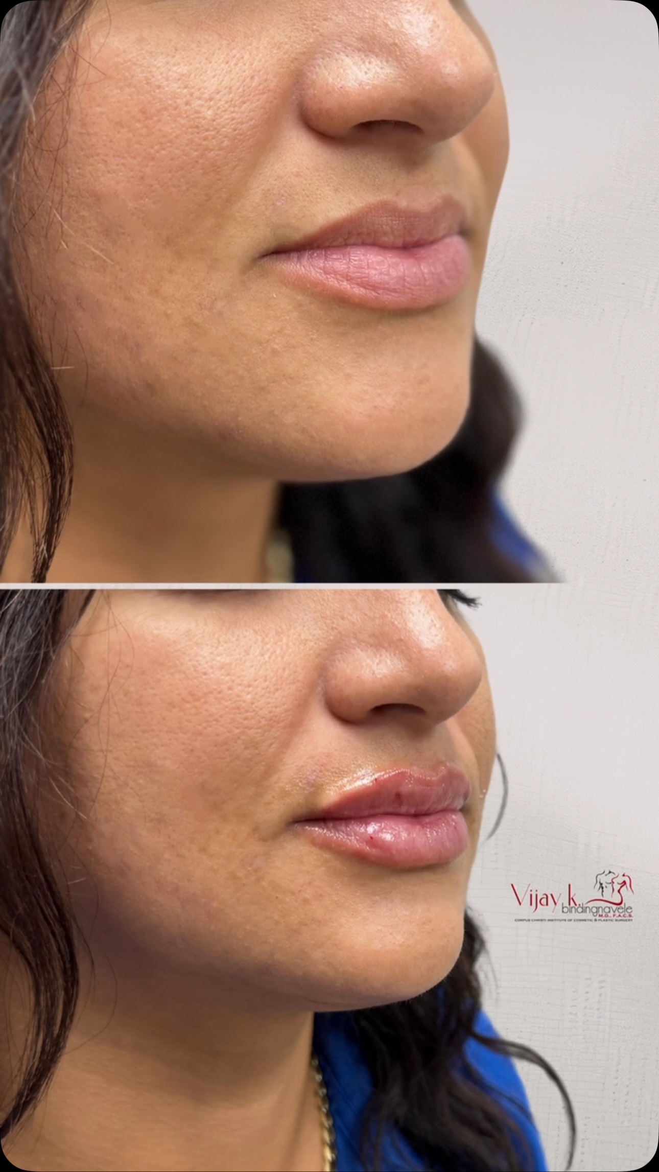 ONE SYRINGE. THAT’S IT. 👄✨, Proof that lip filler doesn’t have to scream “I got filler.” Sometimes the best result is the one that simply makes you think… her lips look SO good. 😍, Eliana, our Nurse 