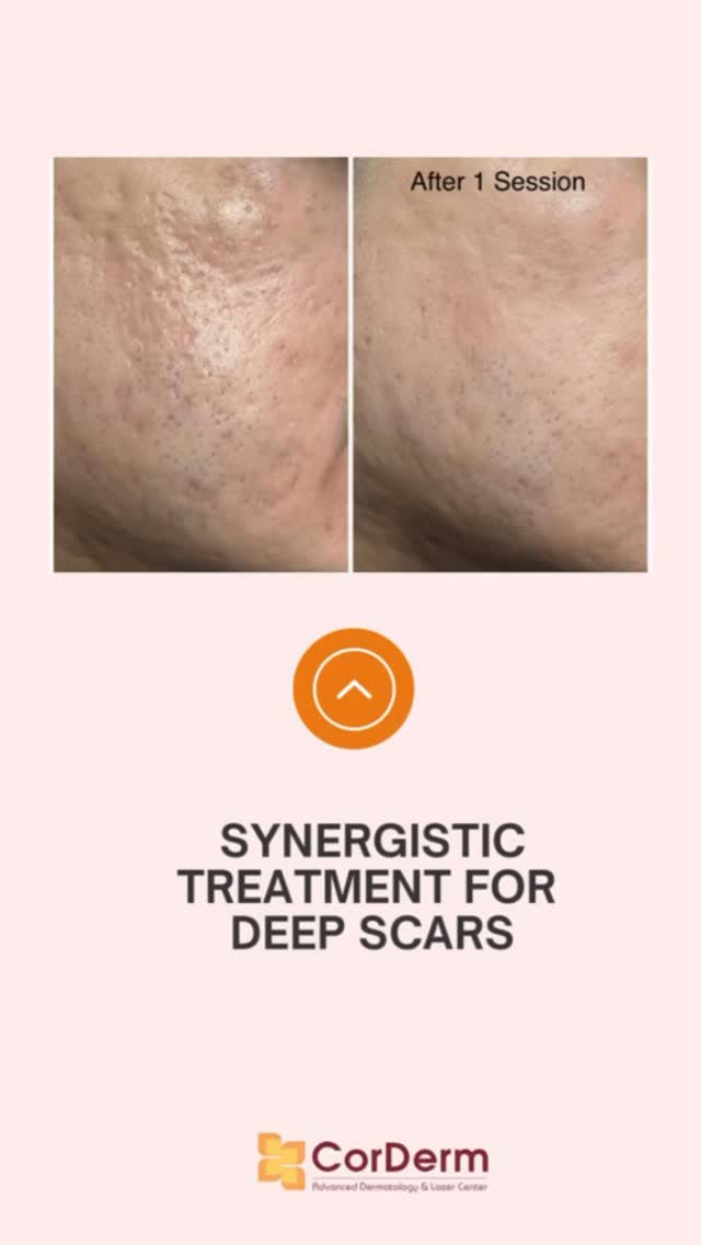 corderm glutathione ✨ SAY GOODBYE TO TIRED-LOOKING NECK LINES — WITH SOFWAVE™ ✨, The face isn’t the only area that shows early signs of aging. Horizontal neck lines and beginning skin laxity can appear even in your BPC-157 Penis Enlargement: What sync Fragrance:Cedarwood