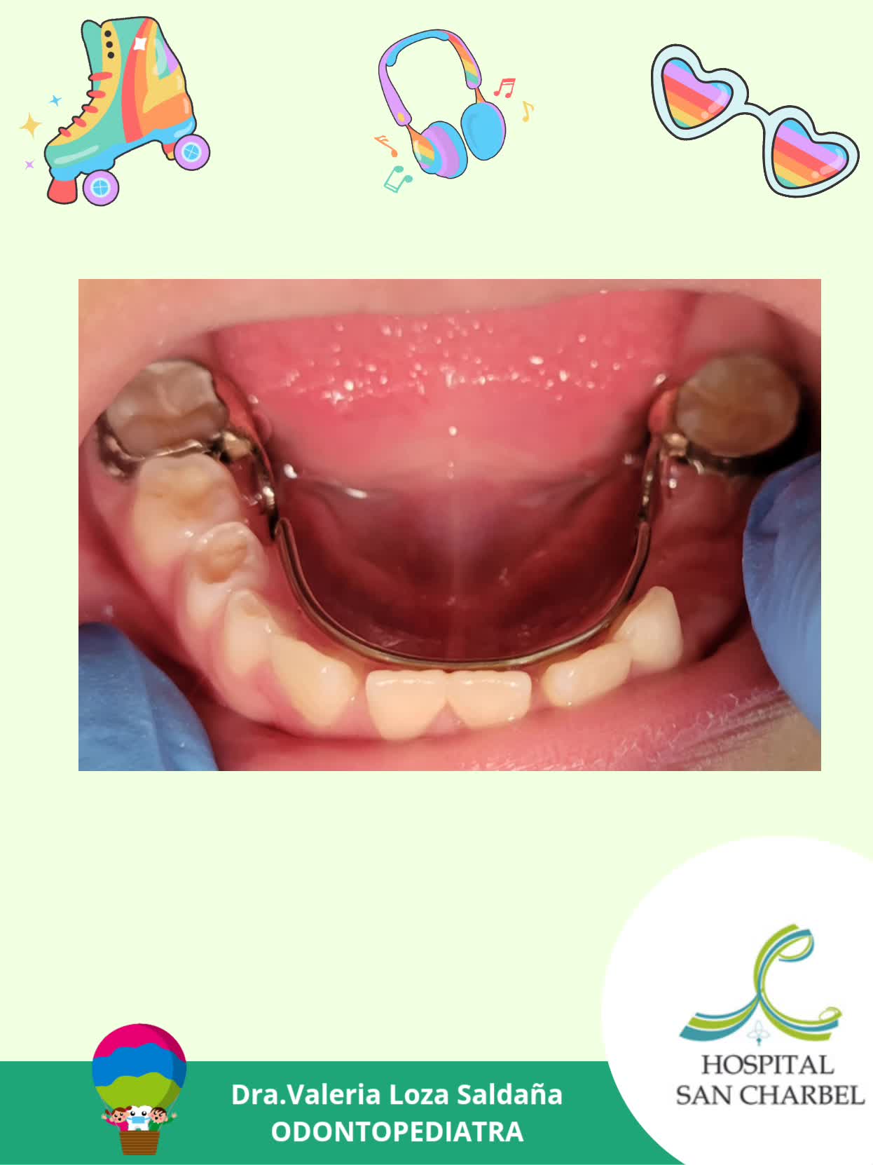 ARCO LINGUAL (mantenedor de espacio) ☝️Al perder piezas dentales ...