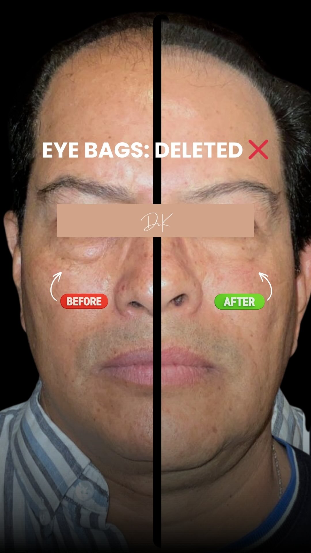 does l carnitine remove eye bags Malar edema vs bags: Causes and treatments Lipo-Mino Size:2 lb. karachi