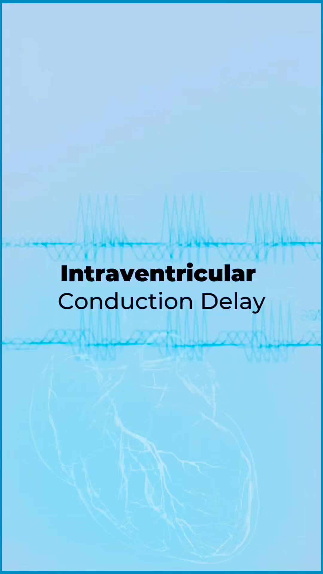 Intraventricular conduction delay (IVCD) is a critical ECG finding ...