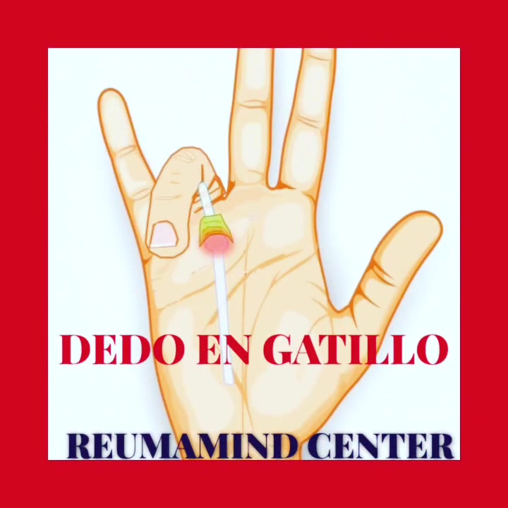 dedo-en-gatillo-el-dedo-en-gatillo-es-una-afecci-n-en-la-que-uno-de-los
