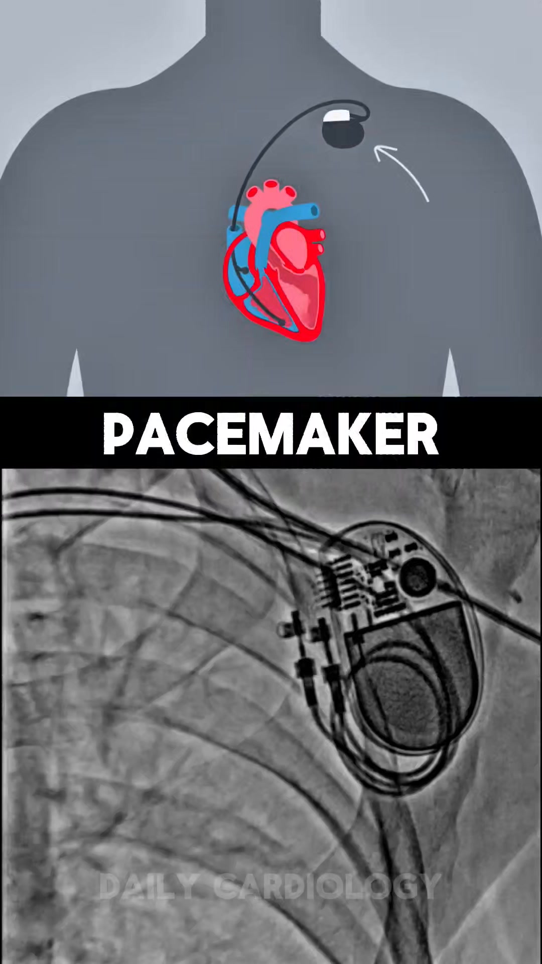 Permanent Pacemaker in Action #reelschallenge #short #cardiology # ...
