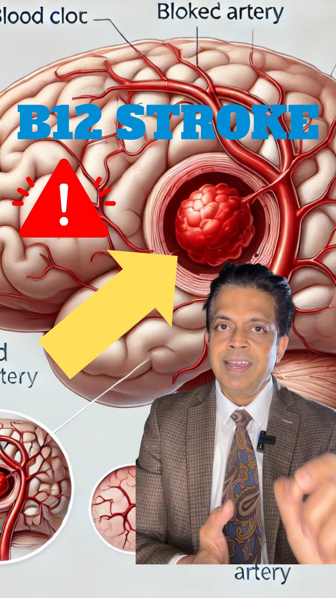 Never miss homocysteine levels in patient of stroke | Sarvesh Bhala