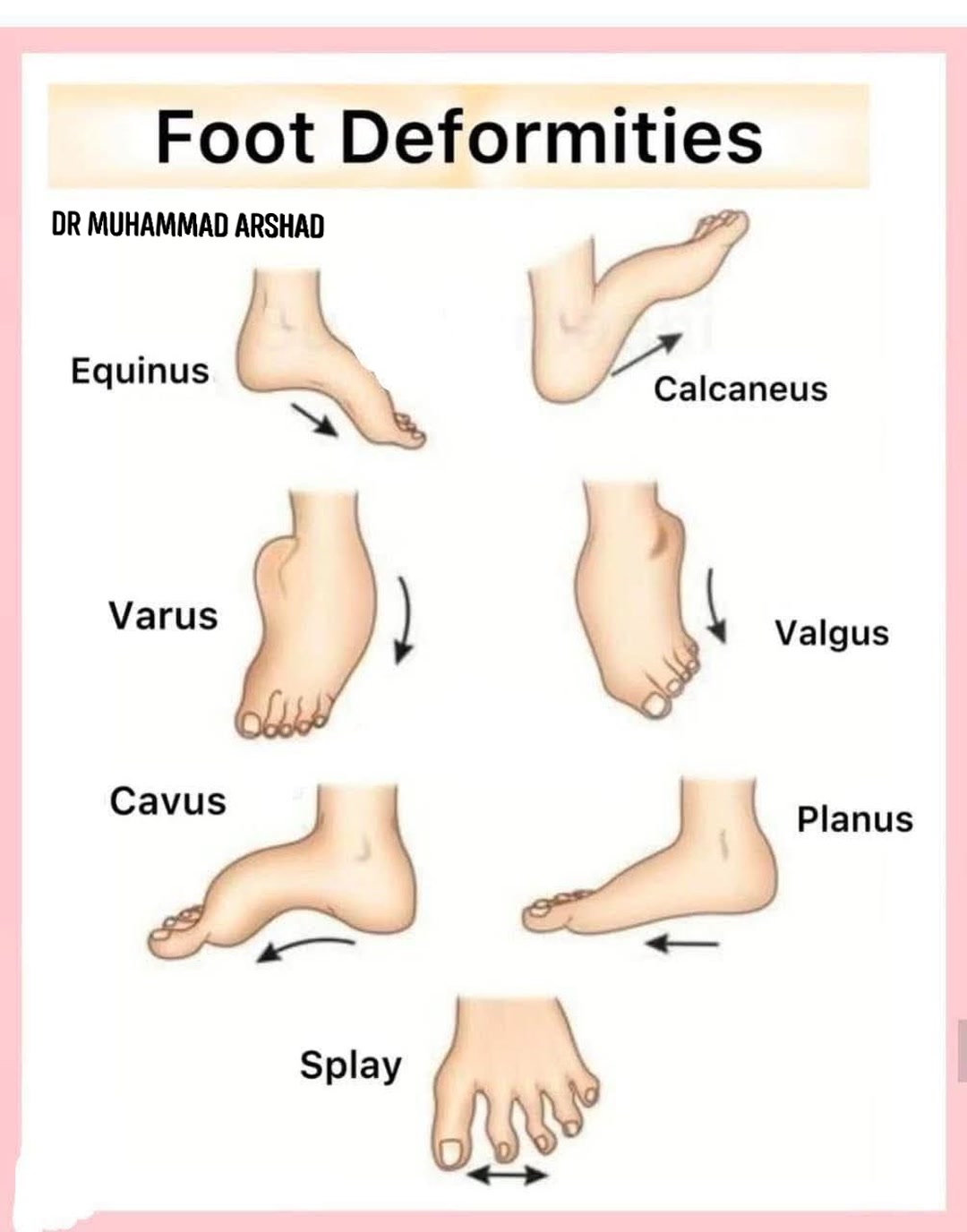 Human Anatomy Group | FOOT DEFORMITIES:- Foot deformities are a ...