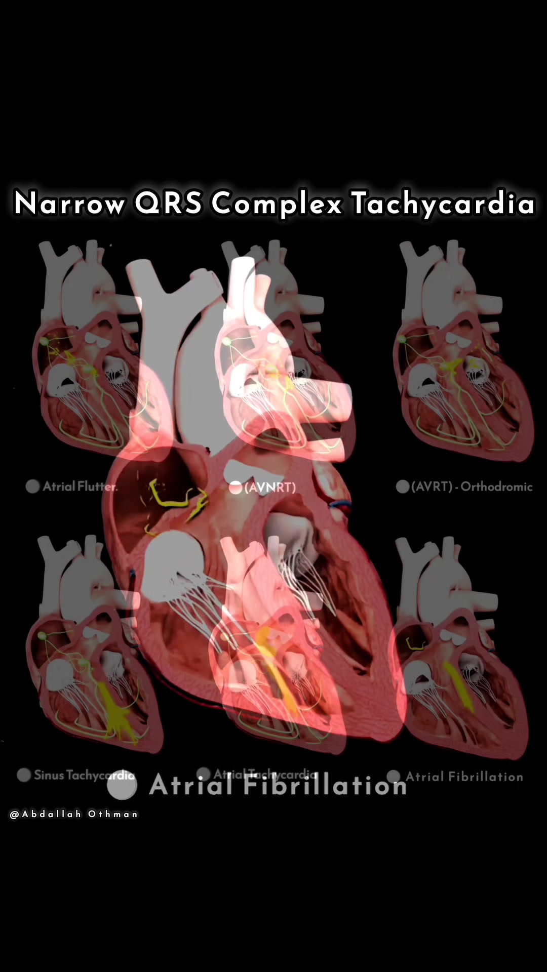 Narrow QRS Tachycardias: A Visual Guide 🫀 A narrow QRS complex ...