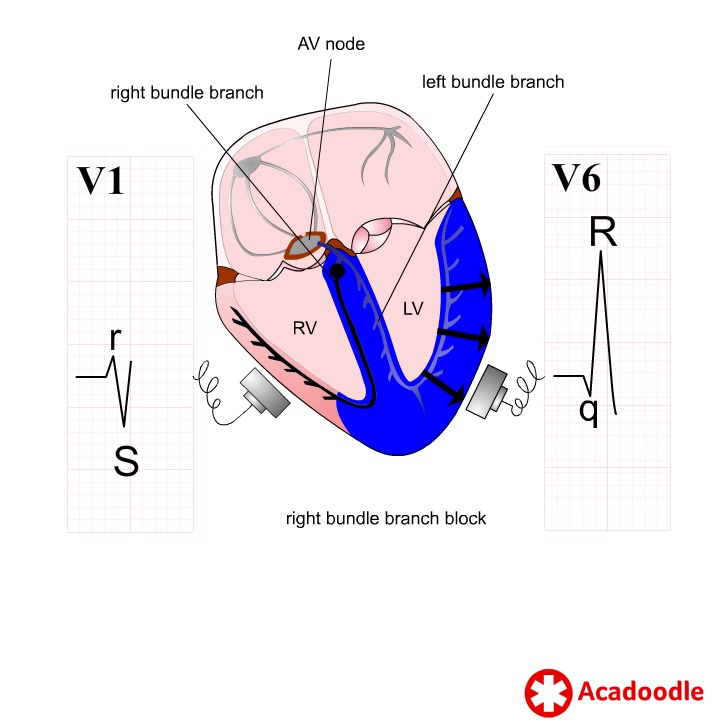 Right Bundle Branch Block - Some Useful Tips. Learn more at https ...