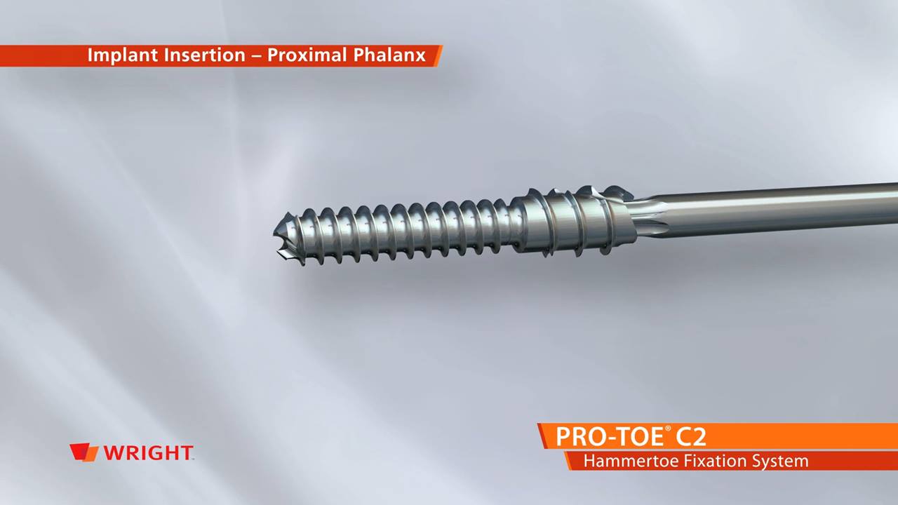 PRO-TOE® C2 Hammertoe Fixation System Animation | By Wright Medical