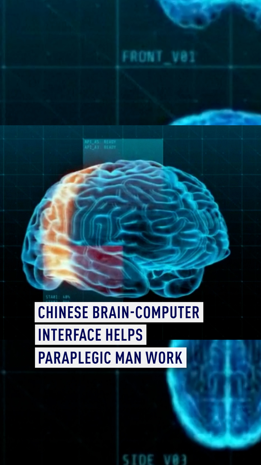 China has made the second successful invasive brain-computer interface ...