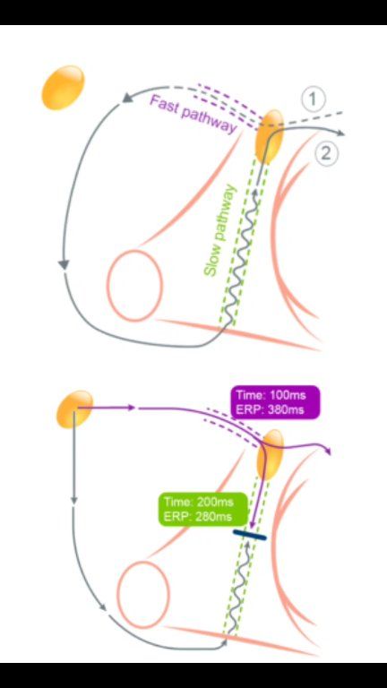 Atrioventricular Nodal Reentrant Tachycardia (AVNRT): Mechanism ...