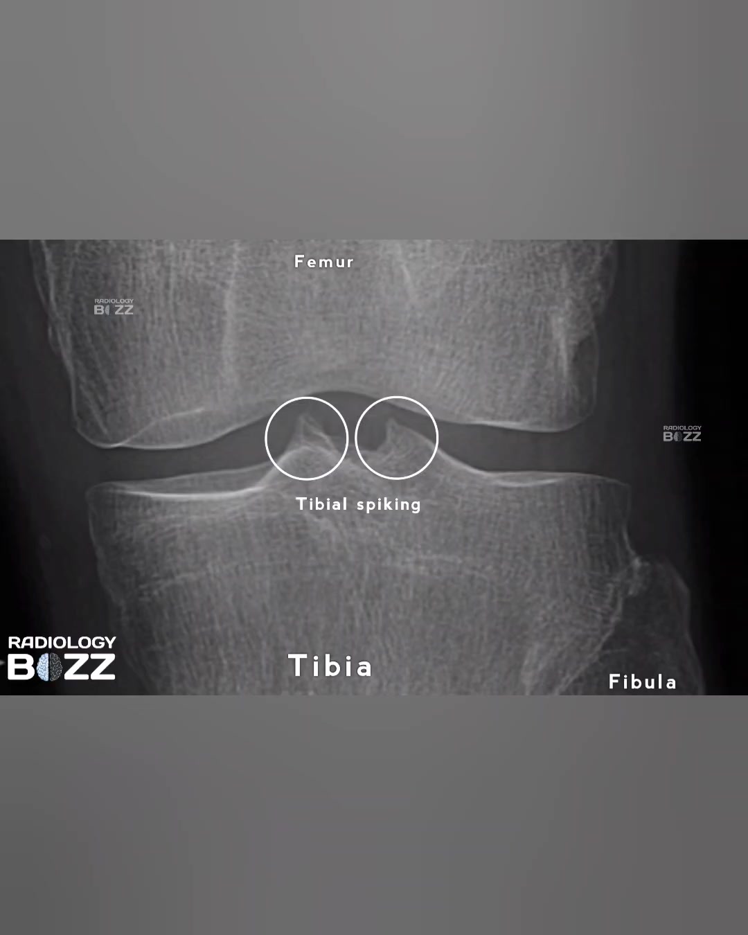 Radiology buzz - Today’s knee AP X-ray shows tibial... | Facebook