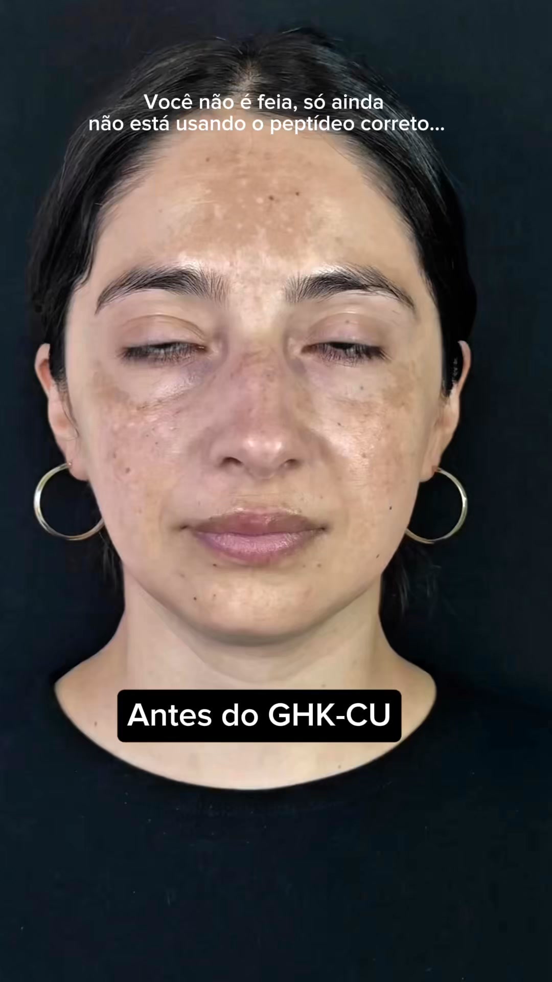 antes e depois do ghk-cu Já sentiu que sua pele perdeu a densidade? O não é apenas um cosmético, é um sinalizador biológico. Este peptídeo de cobre atua profundamente, 
