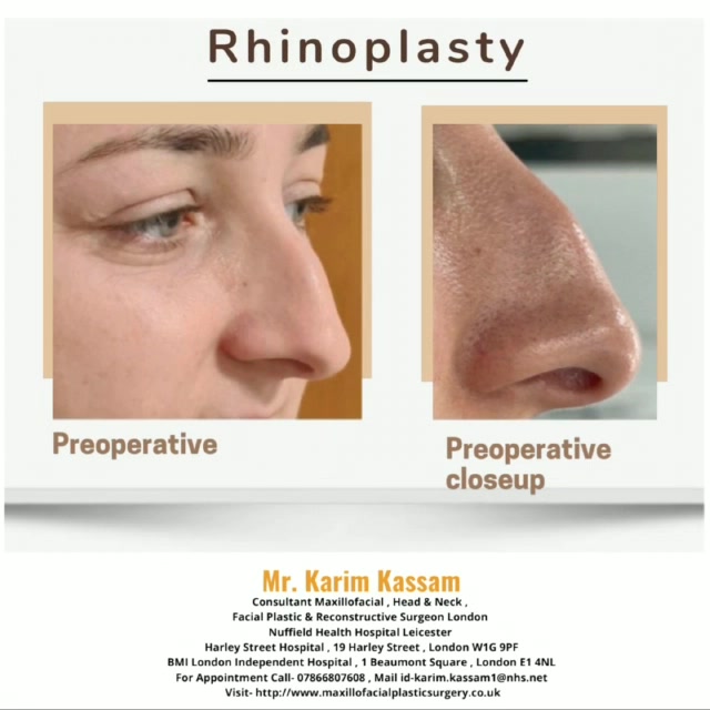 Rhinoplasty can not only enhance the look and function of the nose, but ...