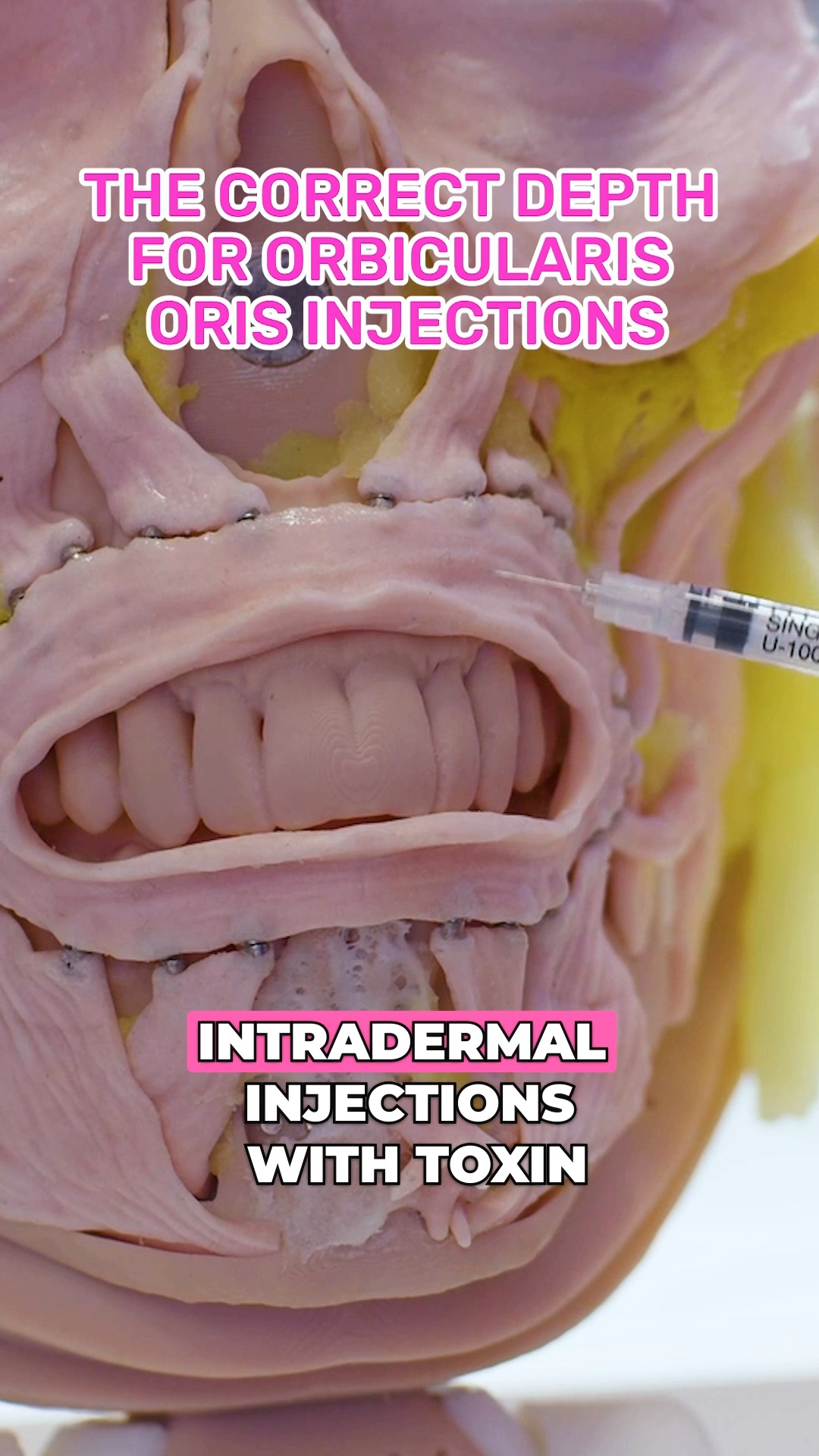 When treating the orbicularis oris, your depth of injection can make or ...