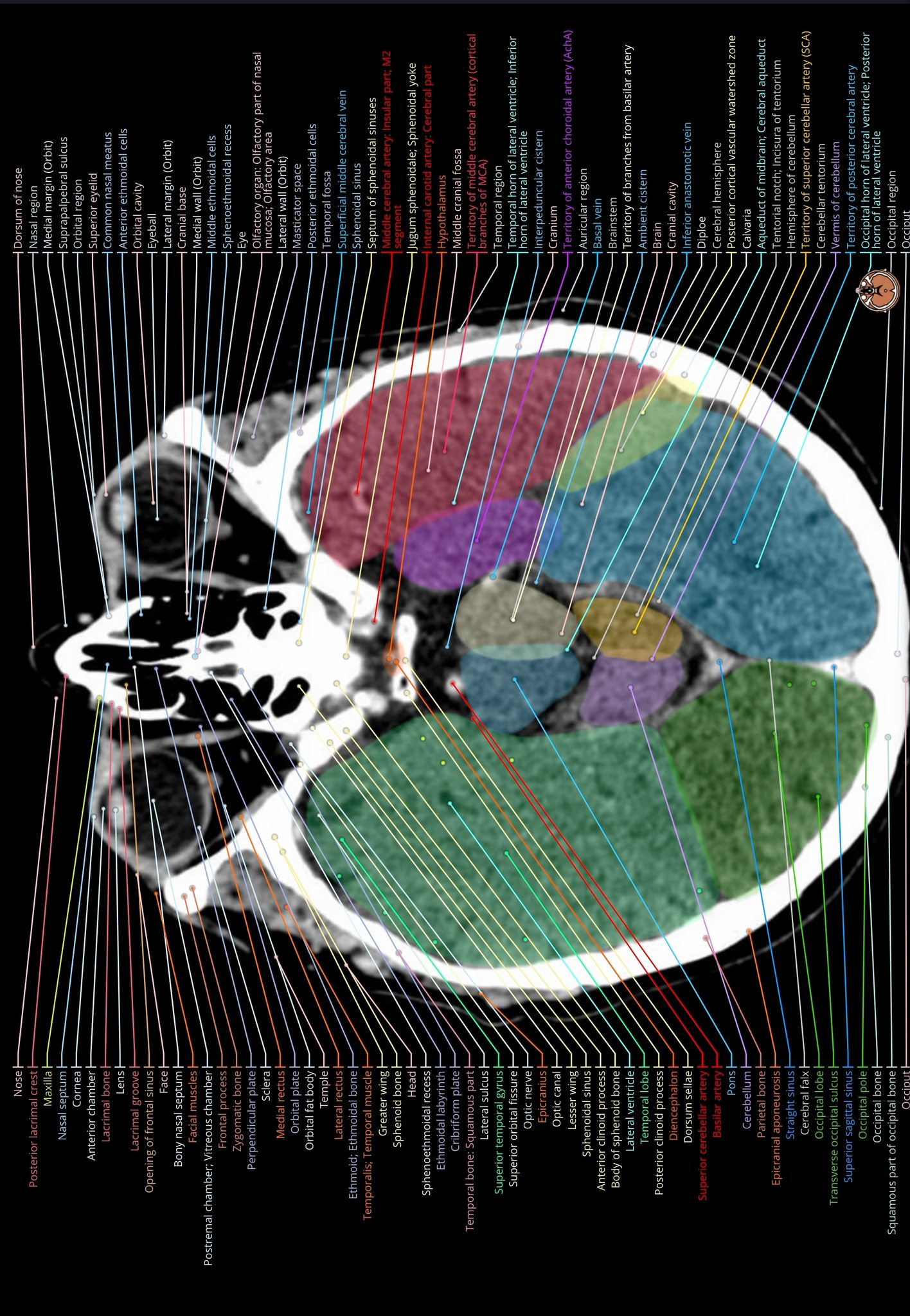Normal cranial CT Scan of the head: brain, bones of cranium, sinuses of ...