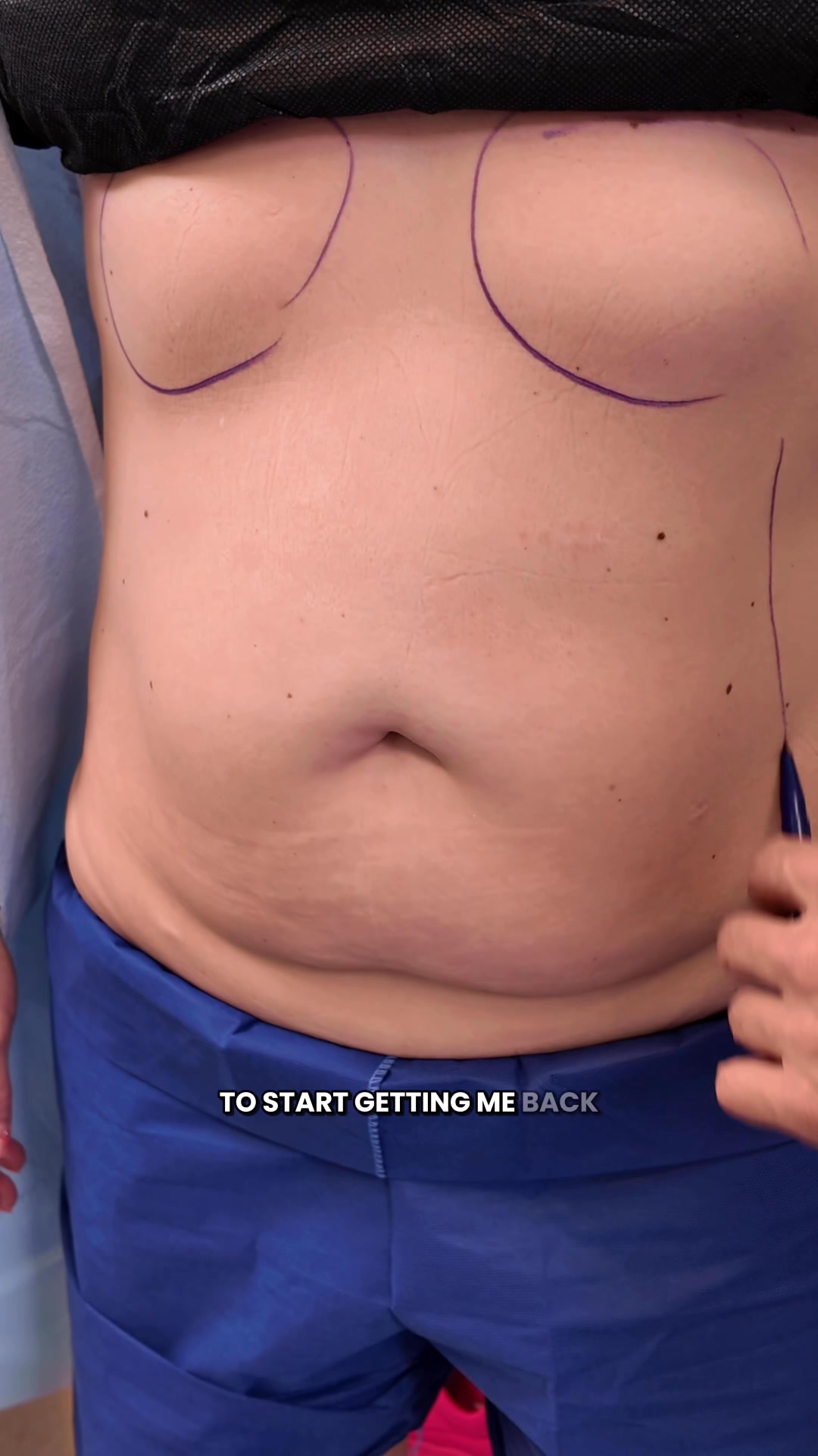 Skye’s lost a total of 75 lbs since starting her Skinny Skye journey! She began with her own lifestyle changes, had lipo to fine-tune her abdominal area, and now stays on track with the Skinny Shot. 