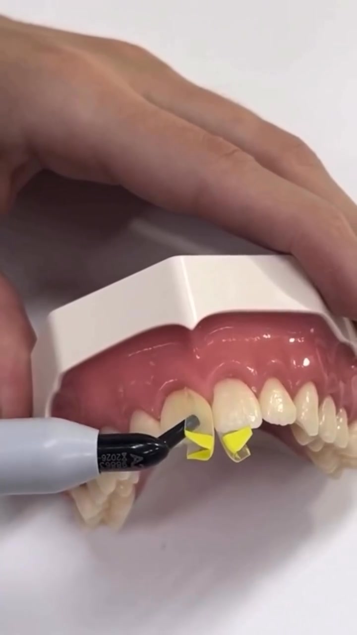 Diastema closure in dentistry