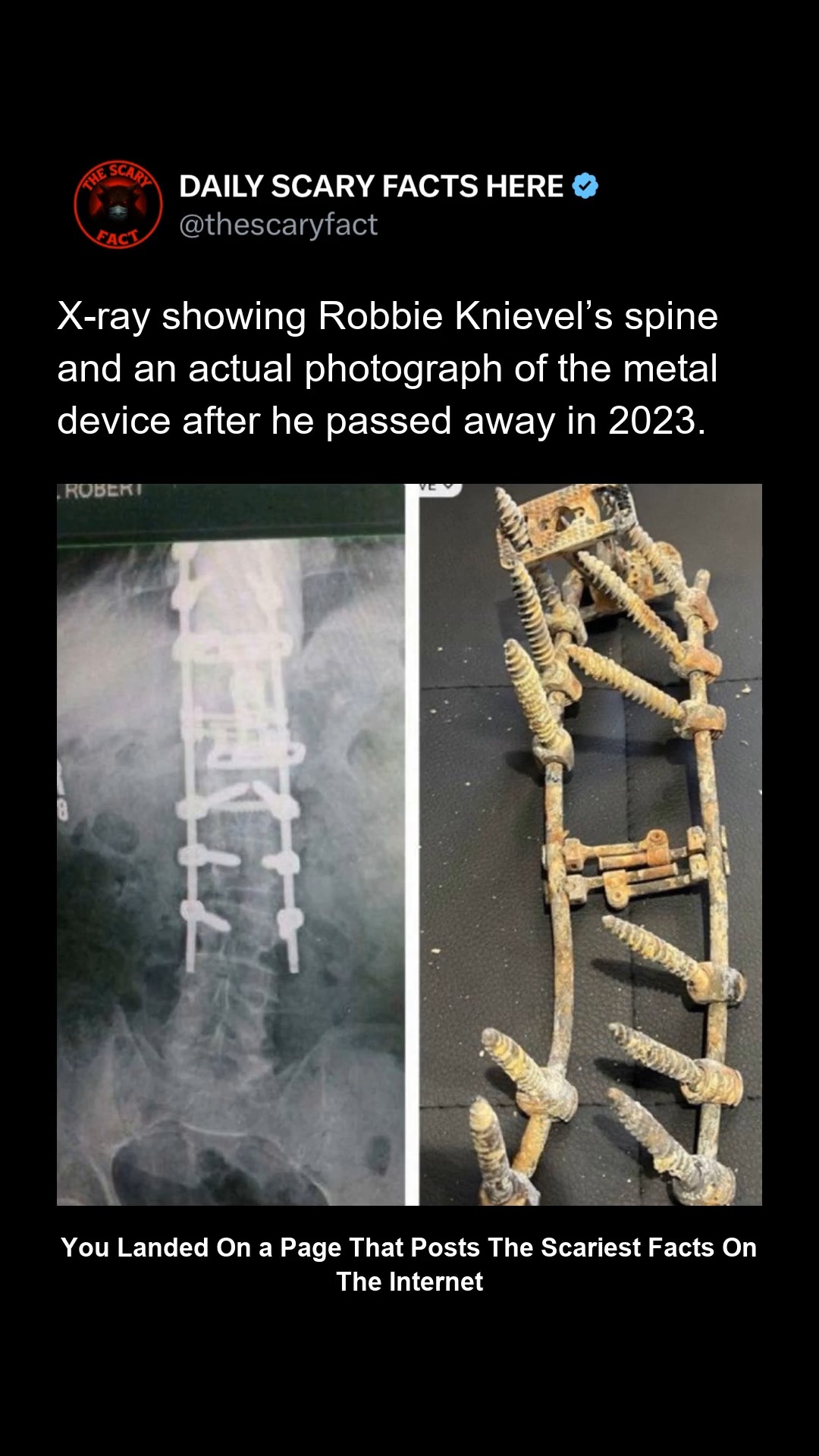This X-ray reveals the extensive metal hardware embedded in stunt ...