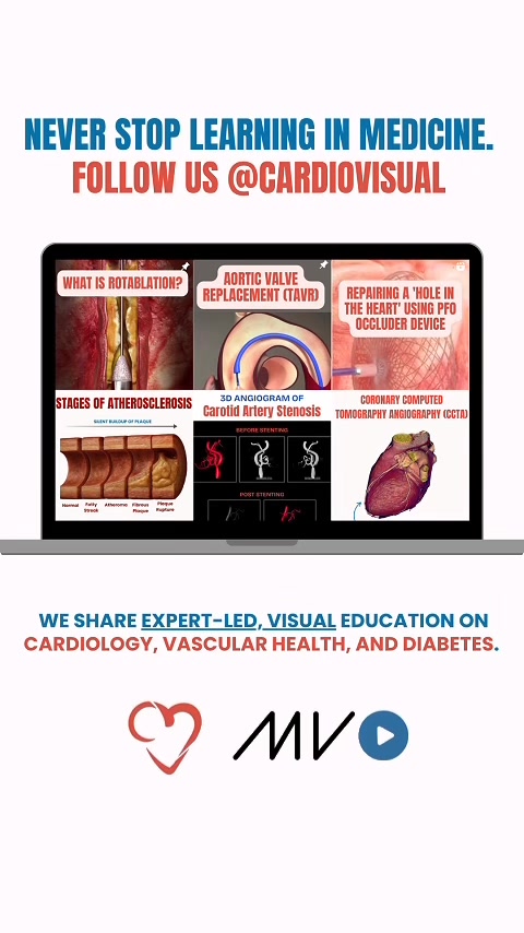 CardioVisual - What is Atrial Fibrillation (AFib)? AFib is an atrial ...