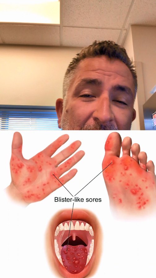 Hand Foot Mouth, aka Coxsackie Virus. #erdoc #handfootandmouthdisease # ...