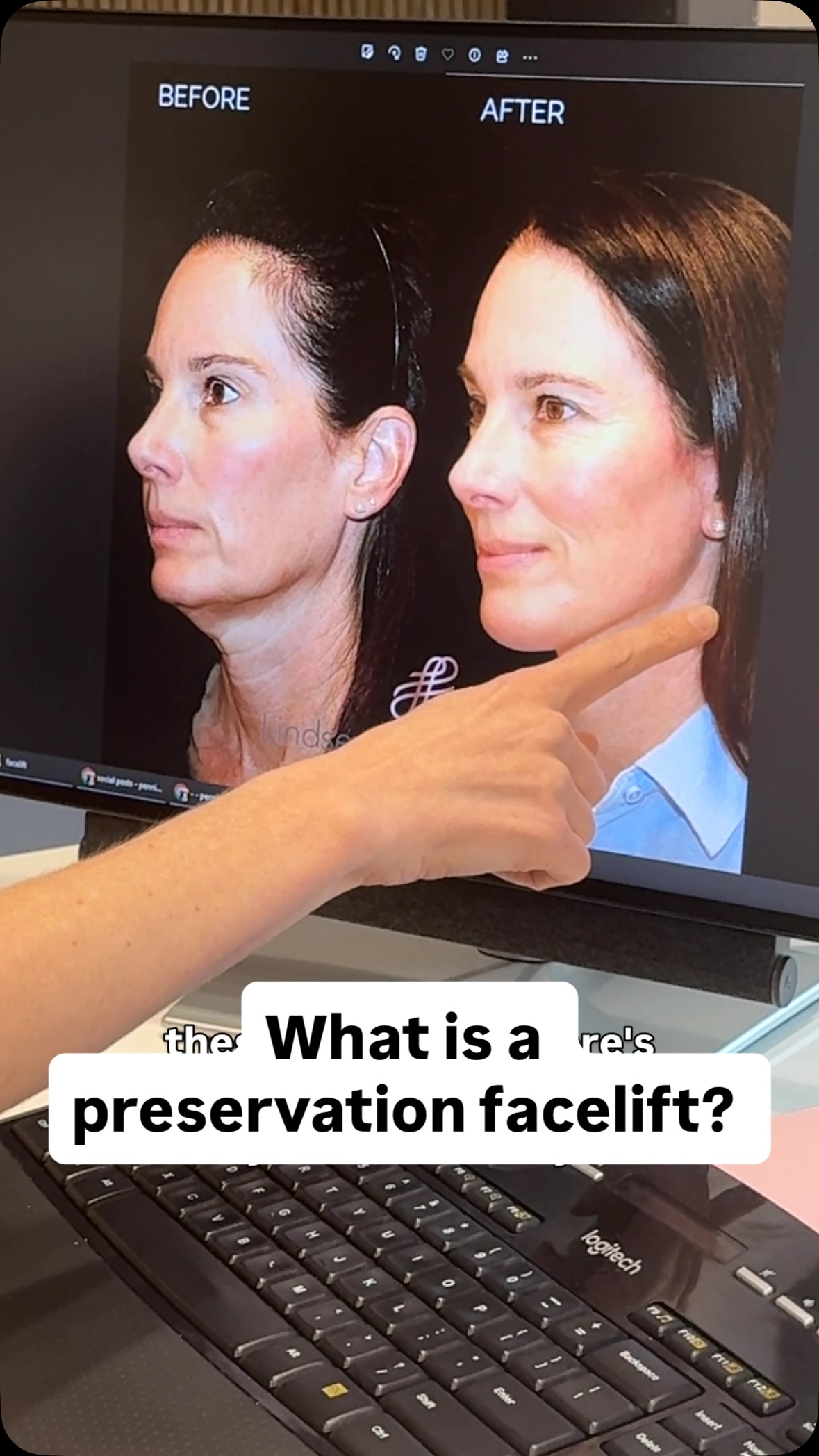 What is a preservation Deep Plane Facelift? It is an advanced surgical ...