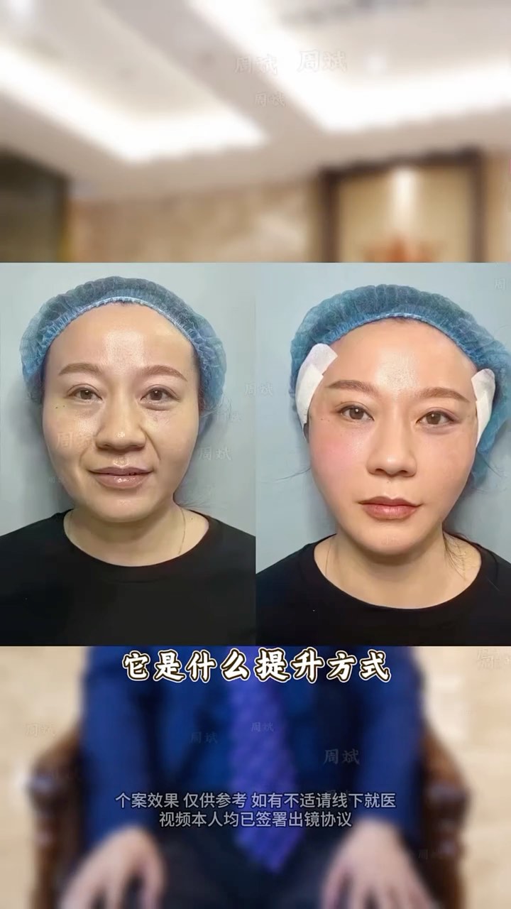 #台灣 #微整#醫美#輪廓提升#抗衰#顏值#美女 #法令紋#淚溝#黑眼圈#去眼袋#筋膜提升#提眉 | Xie Yu | Facebook