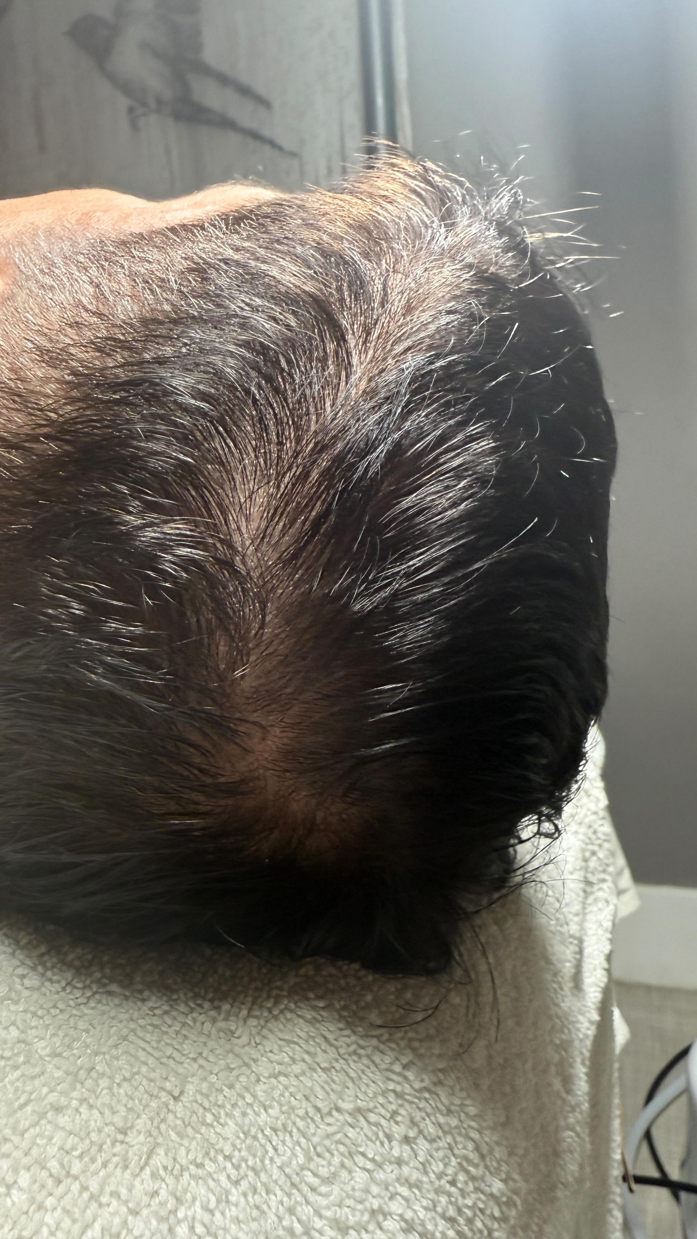 hairloss ahk cu reddit From Bald to Bold! Treating My Scalp for Balding 🔍 Usage Tip Size:1000 mcg/ml - 1 box (10amp. x 1ml) SLU-PP-332 5MG - AminoQuest Small Animal Injectable Vitamin B12