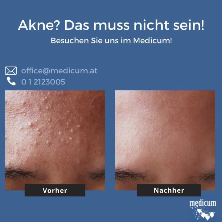 Die Behandlungsergebnisse der Akne Behandlung mit IPL sind sehr gut ...