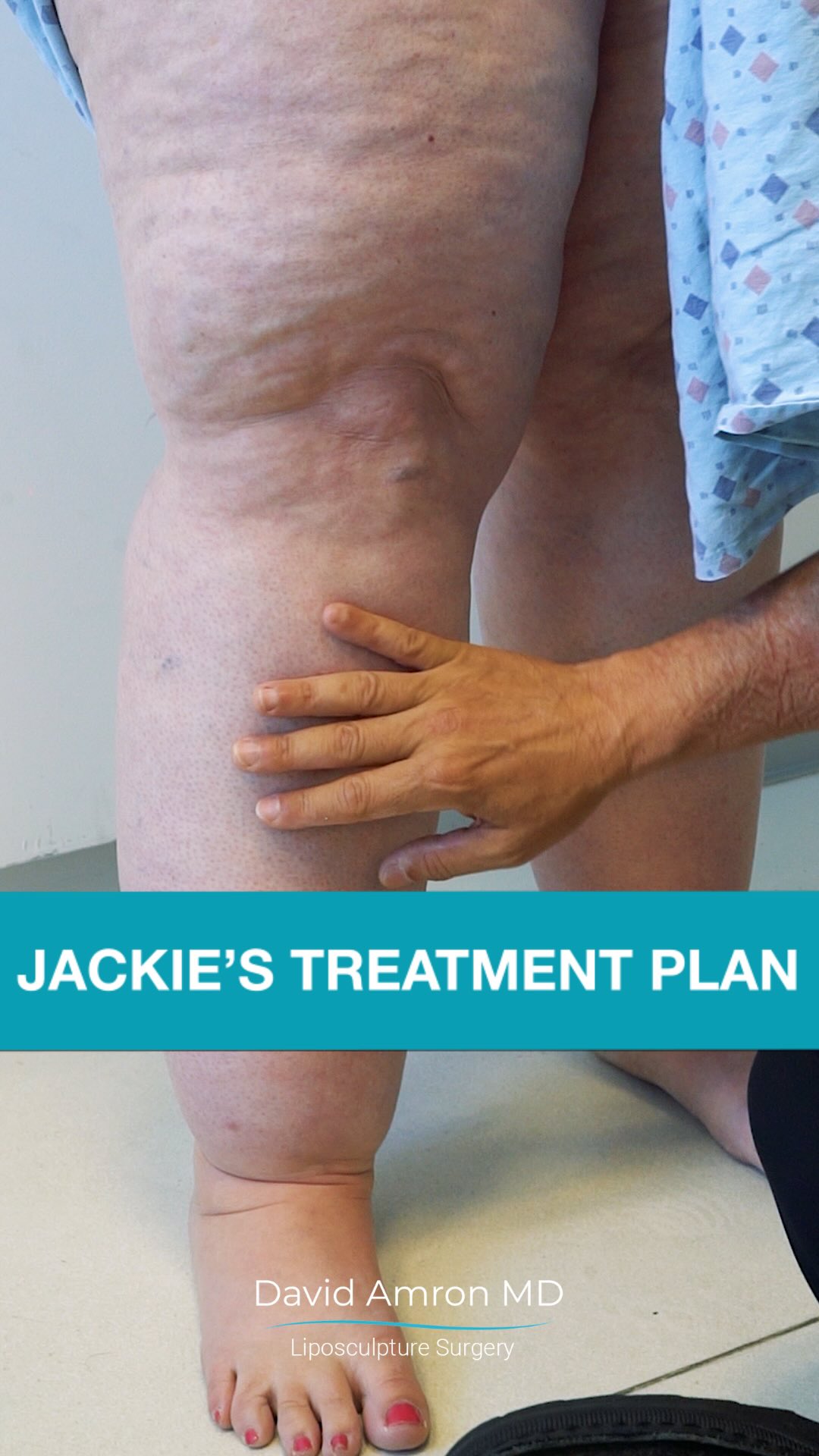 What happens when you stop taking Zepbound (Tirzepatide) for lipedema? Many patients don't realize how much it helps until they go off it—especially before su | Atlantic Surgical Associates