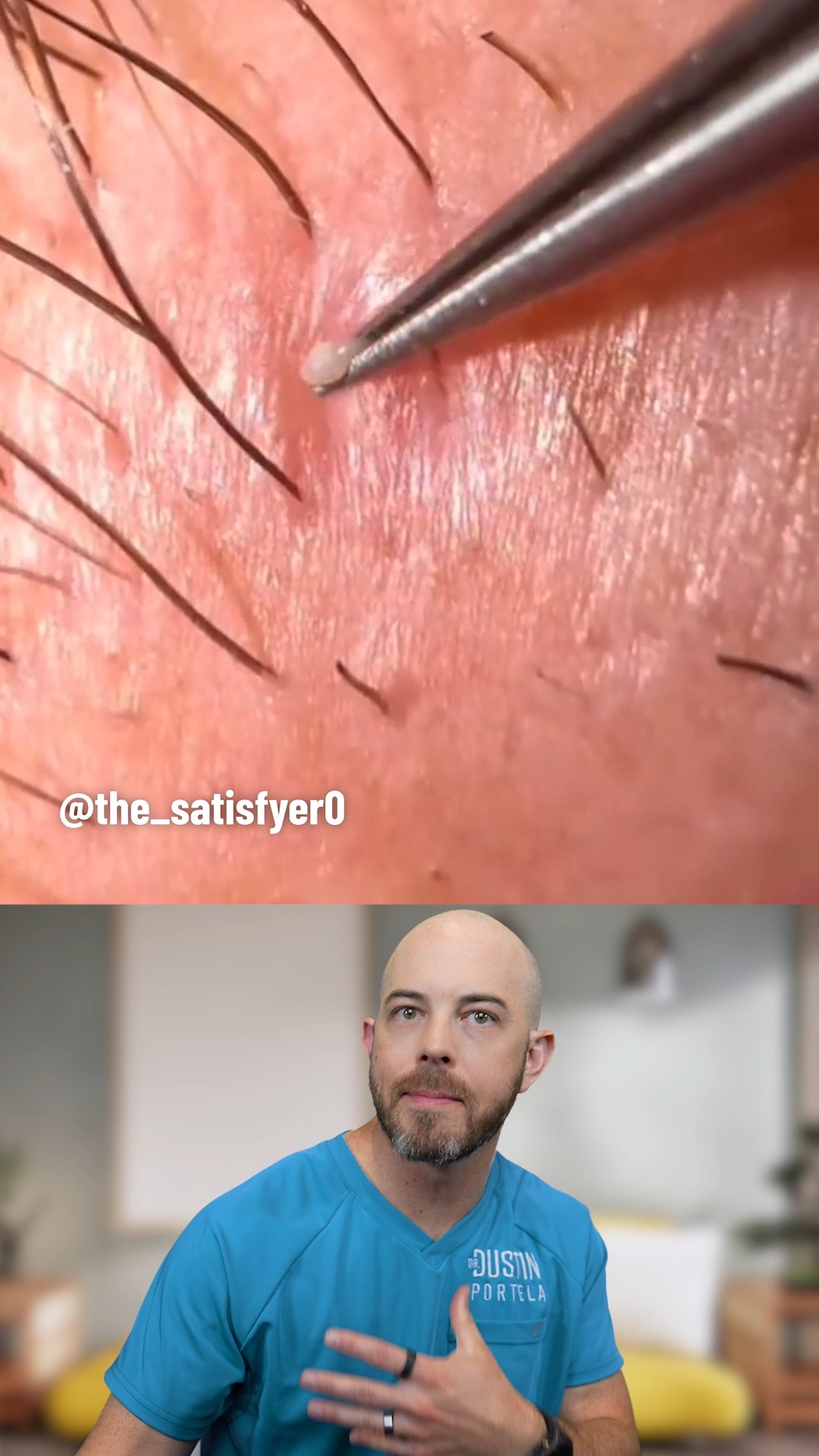 This pustule pop tricked me! (credit: @the_satisfyer0 on TT) #skincare ...