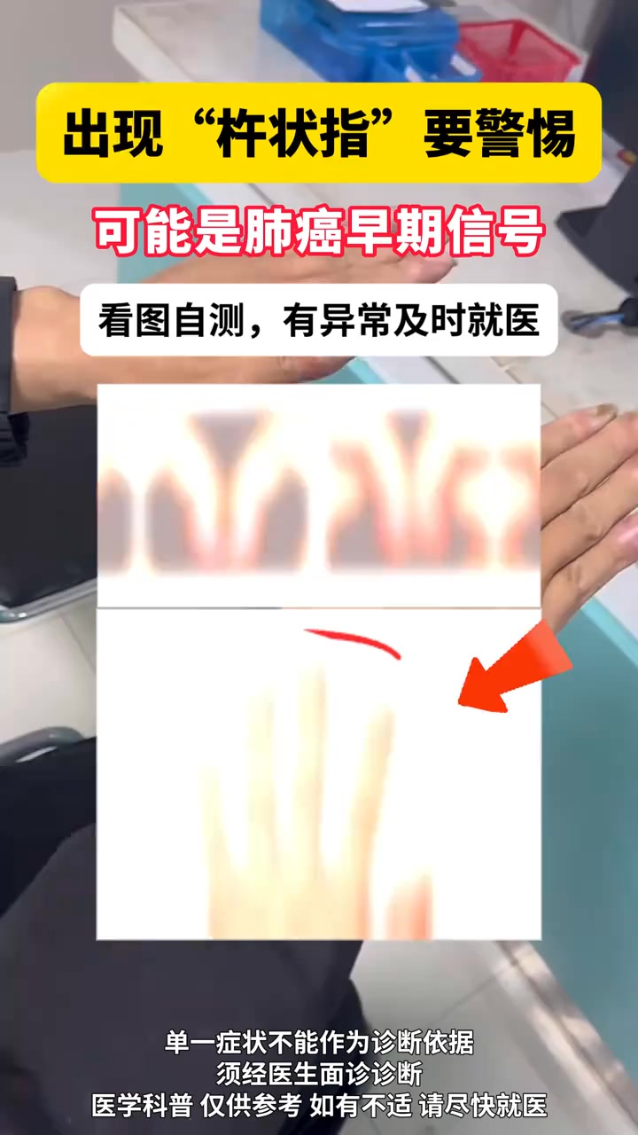 看看自己的手指，警惕杵狀指！警惕肺部問題！ #肺部健康 #杵狀指 #肺部疾病 #抖出健康知識寶藏 #健康科普 | 一直都是奶淇琳呀 ...