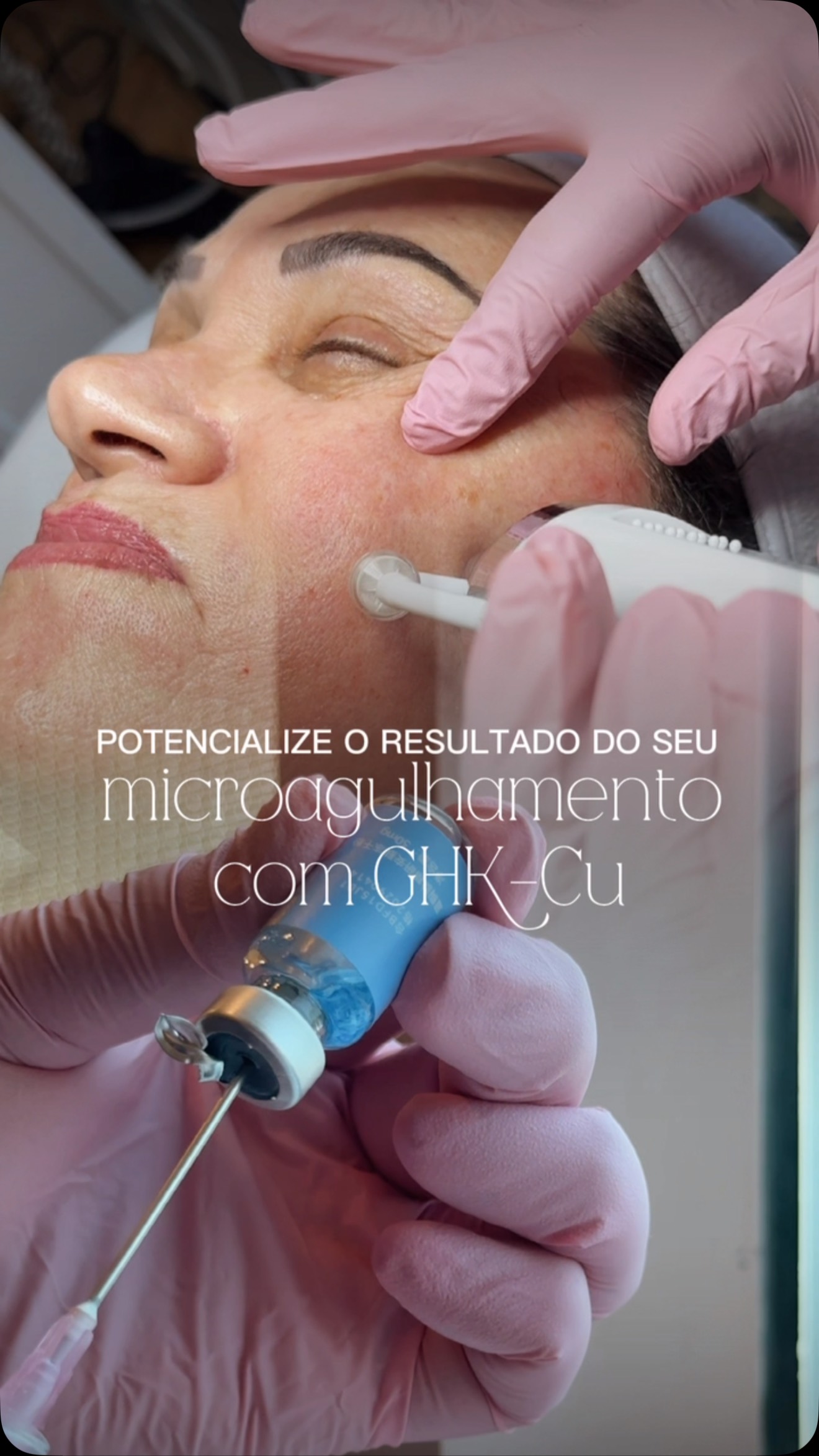 O GHK-Cu é um peptídeo bioativo que auxilia a pele no processo de regeneração, estimula a produção de colágeno e favorece uma recuperação mais eficiente, deixando a pele ainda mais preparada para 