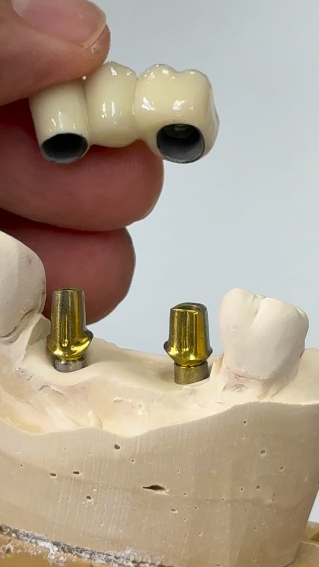 Wednesday custom mini syton hybrid implants cases! @dr.johnvargas in ...