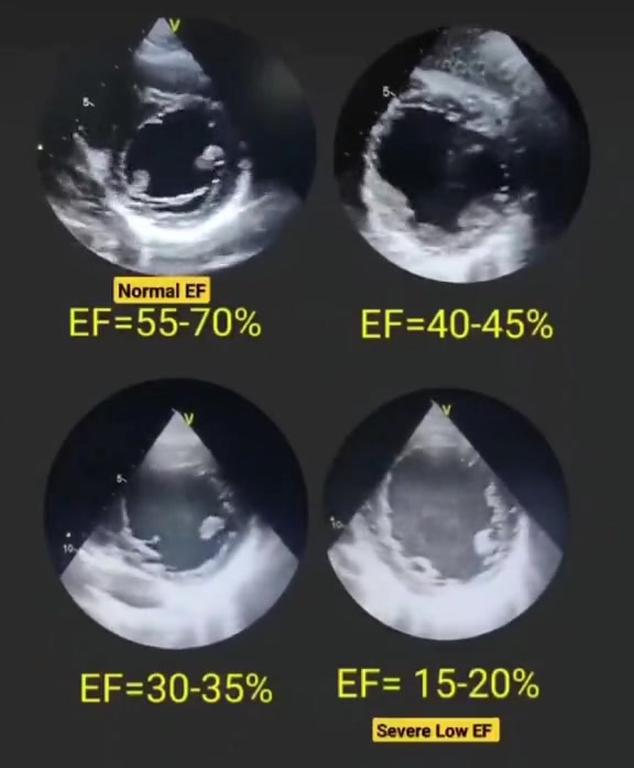 🧠 KNOW YOUR HEART’S PUMPING POWER: Ejection Fraction Explained 🩺 ...