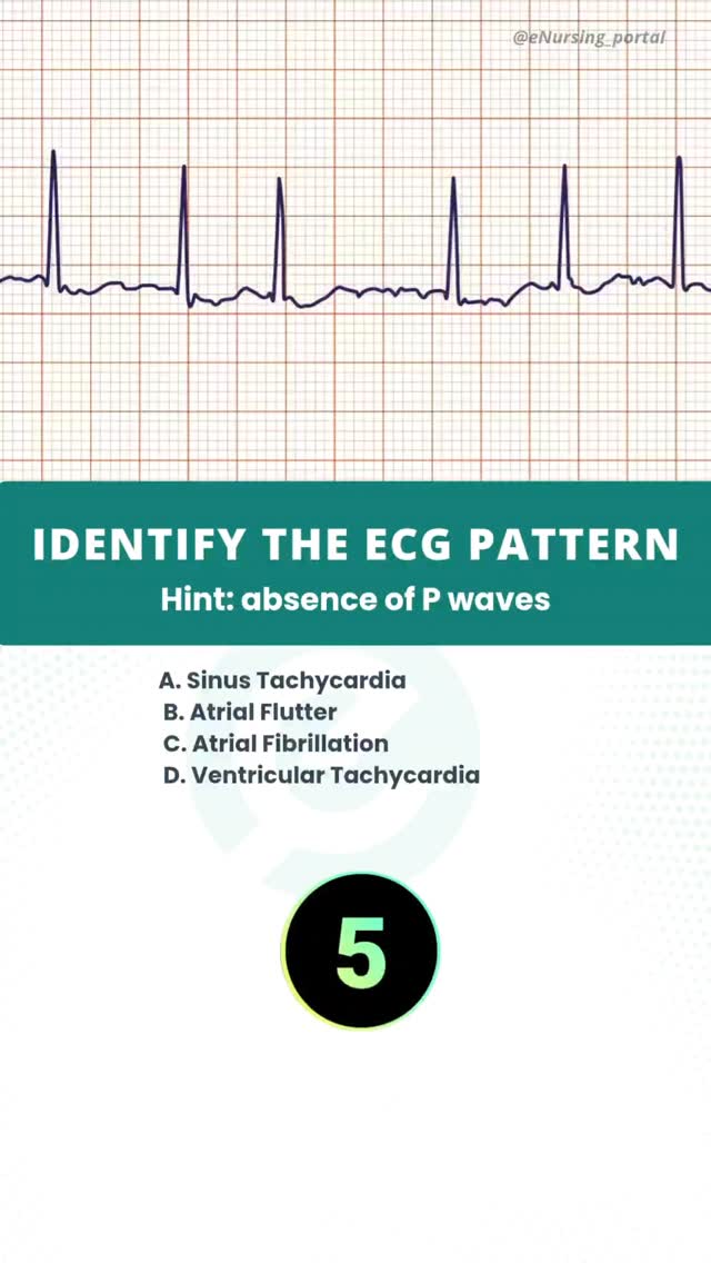 Can you identify this ECG pattern? 👀 Hint: Notice the absence of P ...
