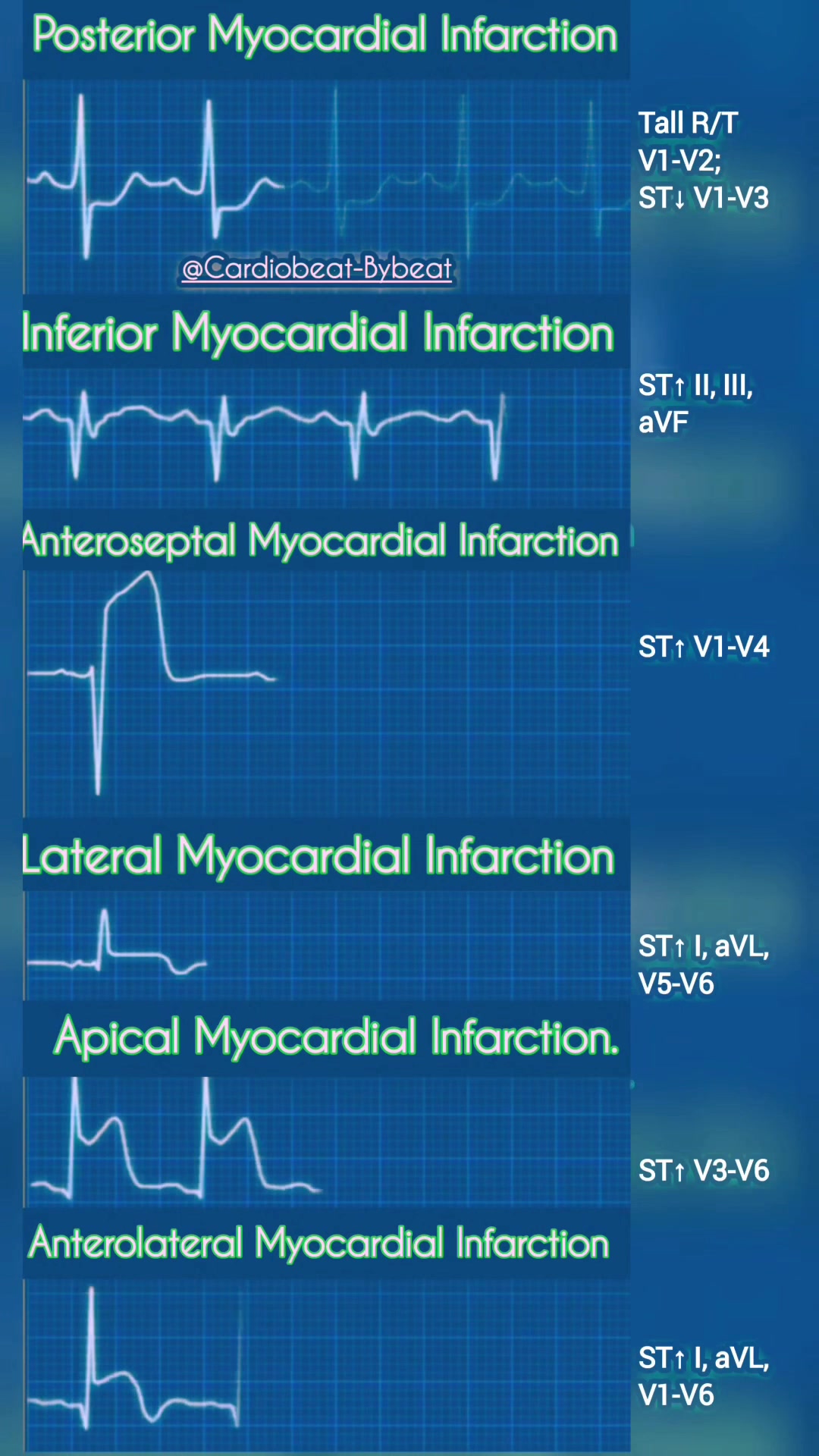 Myocardial Infarction. 🫀 MI Location = Clues to the blocked artery ...