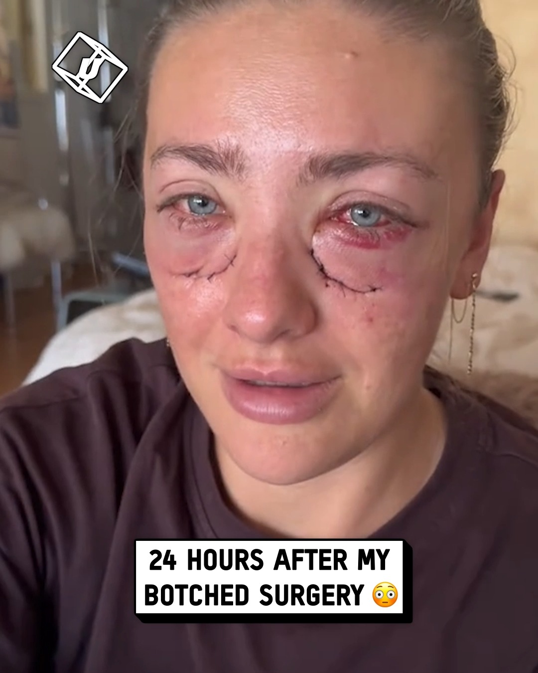I thought my lower bleph surgery was botched... 👀🤯 #botched #surgery ...