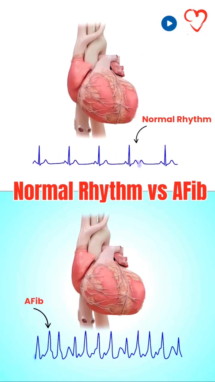 Atrial Fibrillation (AFib) vs. Normal Rhythm: A Visual Guide ...