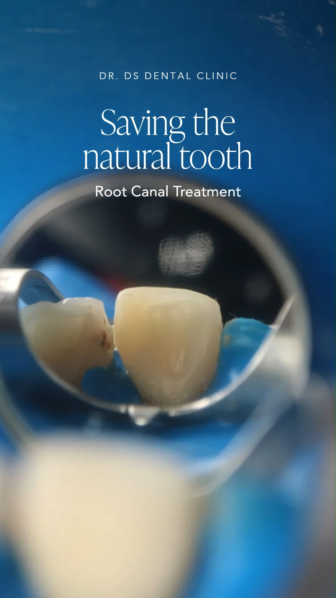 Tooth pain often leads to the instinct to extract. Losing a
