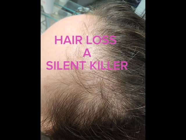 bpc 157 to scalp reddit Gen Z men are MAD stressed about hair loss. A 2024 study found that 84% of Gen Z men would 