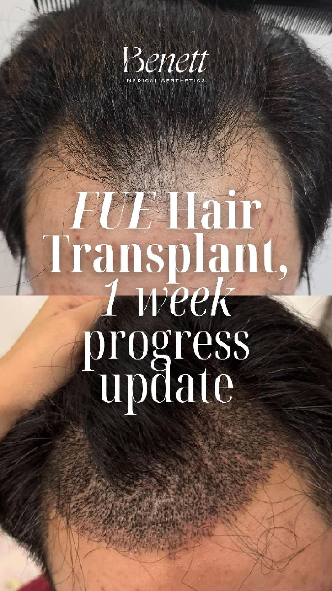 Day 14 after the hair transplant: The healing process is well underway! Most of the scabs have cleared, revealing the first signs of new hair growth starting to come through 💪🏼 The