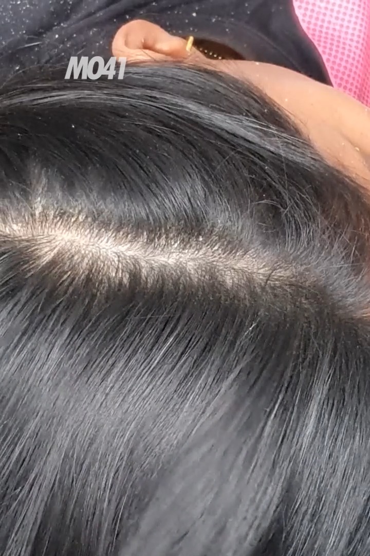 Relaxing ASMR With Combing And Scratching Dandruff Off Scalp #Dandruff ...