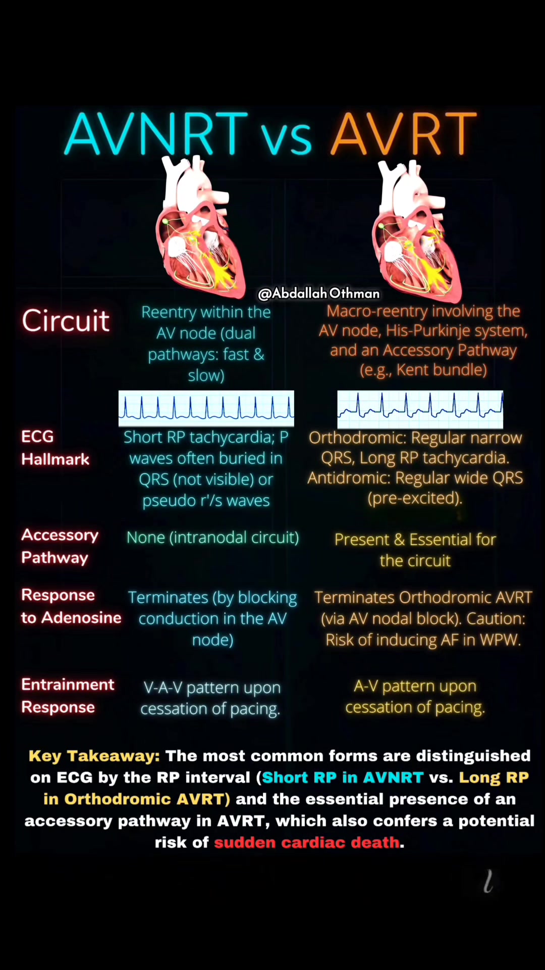 🔍 AVNRT vs. AVRT: Cheat Sheet Master the critical differences between ...