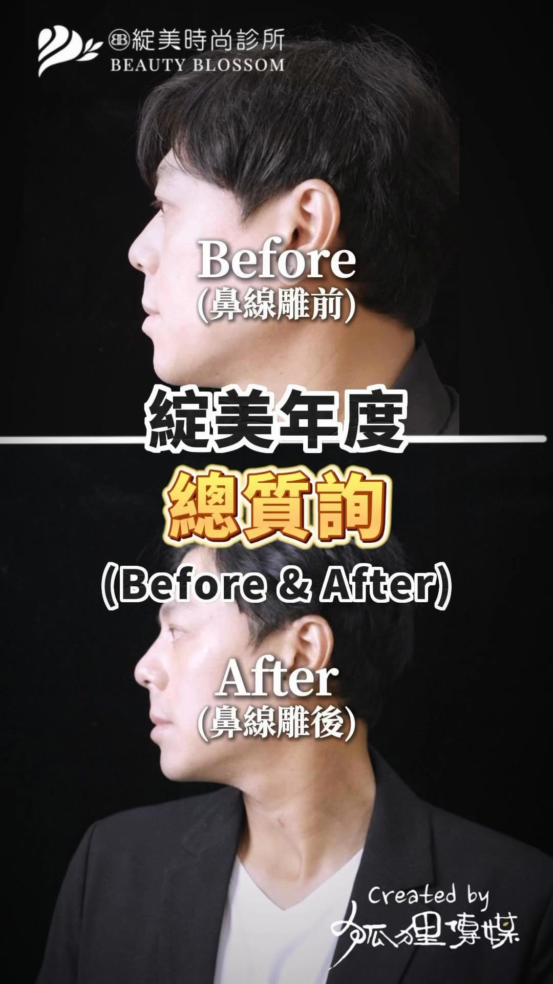 「綻美年度總質詢 · 實測篇」 Derrick老闆在總質詢後 正式啟動了「美麗專案」 索夫波+鼻線雕 1+1大於2的效果 從施術過程到術後對比 ...