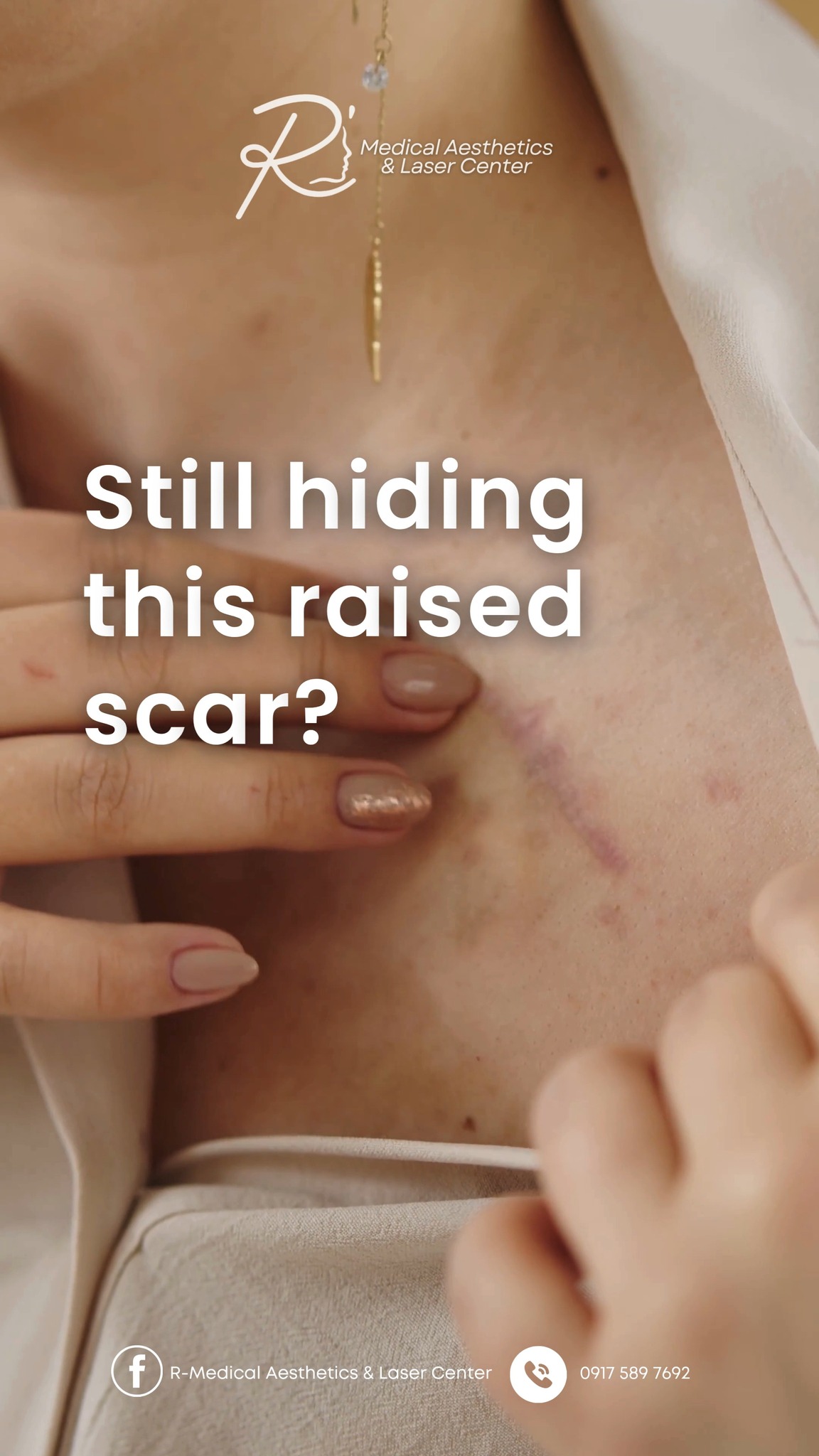 👀 𝑺𝒕𝒊𝒍𝒍 𝒉𝒊𝒅𝒊𝒏𝒈 𝒕𝒉𝒂𝒕 𝒓𝒂𝒊𝒔𝒆𝒅 𝒔𝒄𝒂𝒓?, It might not be an ordinary scar… it could be a keloid., Keloids can develop after piercings, acne, surgery, or even a small cut—and they may continue to grow over 