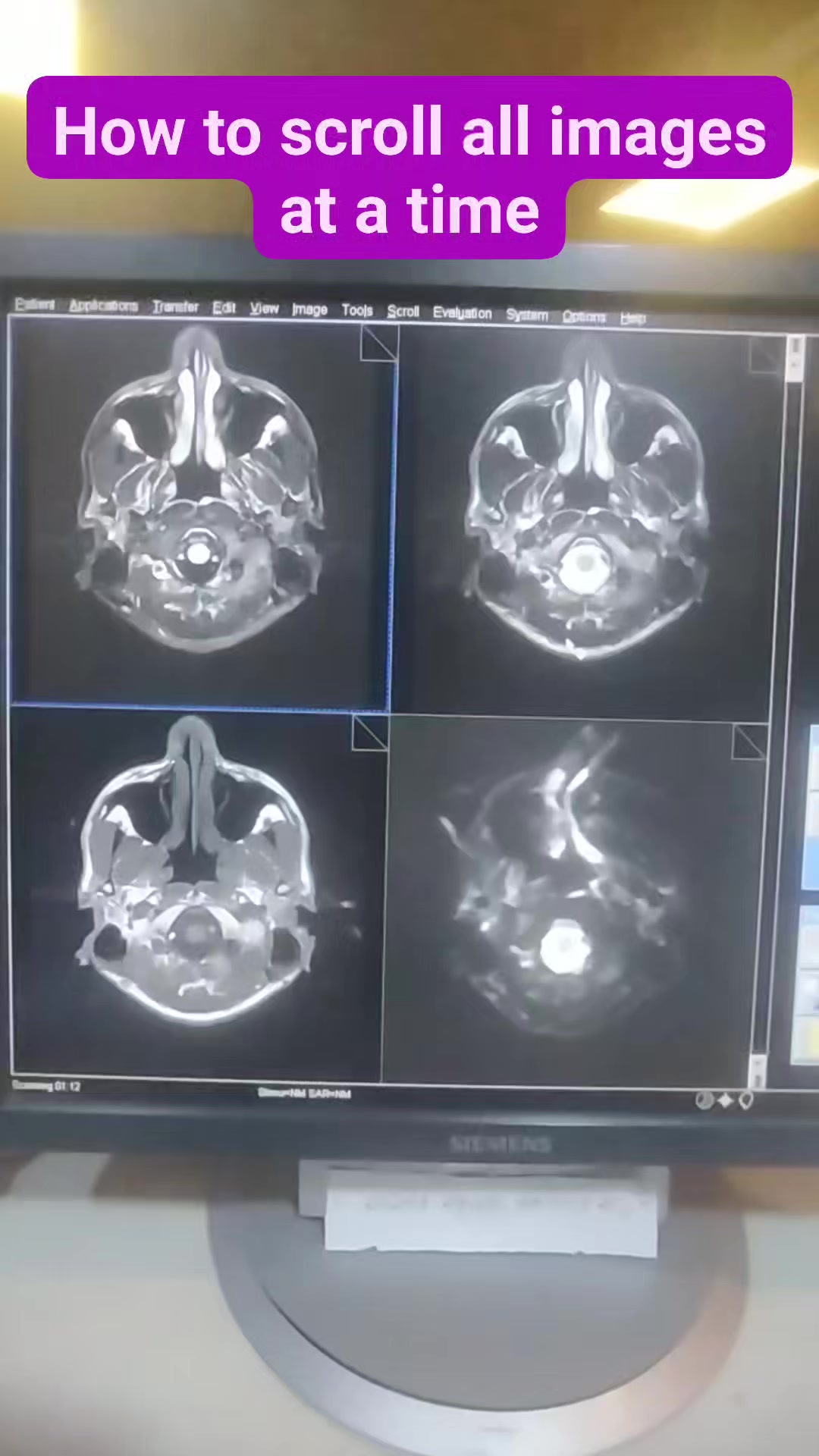 How to scroll all images at a time in SIEMENS MRI #MRI #radiology # ...